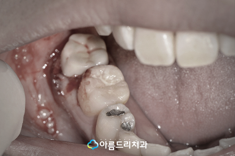 치아재식술 자연치아를지키는 방법 관련 이미지 9