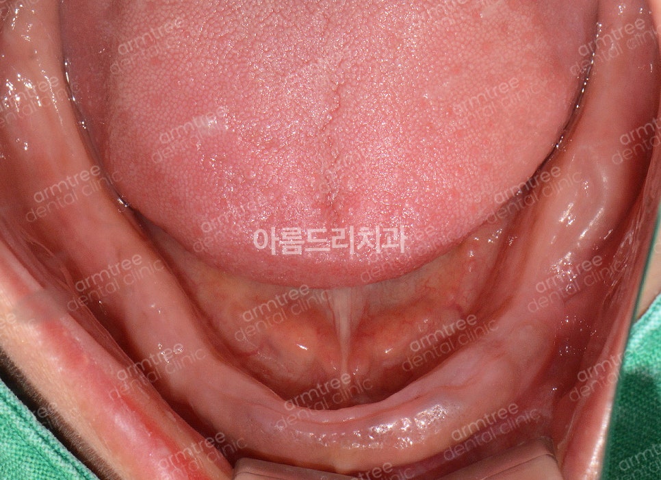 전체임플란트 전악임플란트 전후 아름드리치과 진료일기 관련 이미지 7