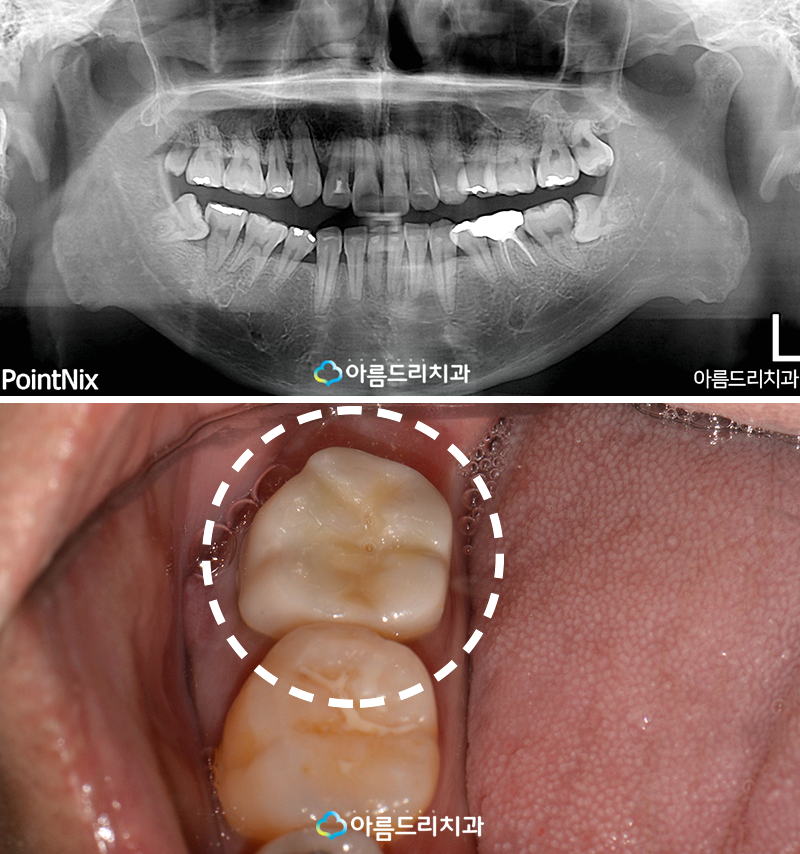 치아재식술 자연치아를지키는 방법 관련 이미지 3