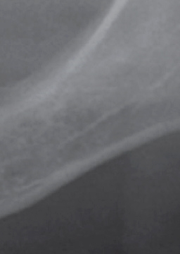 반포치과 전악임플란트는 풀아치 임플란트로 관련 이미지 14