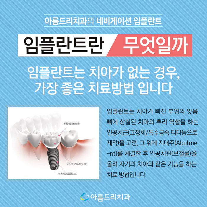 디지털인플란트 치아인플란트 정확도 차이 관련 이미지 2