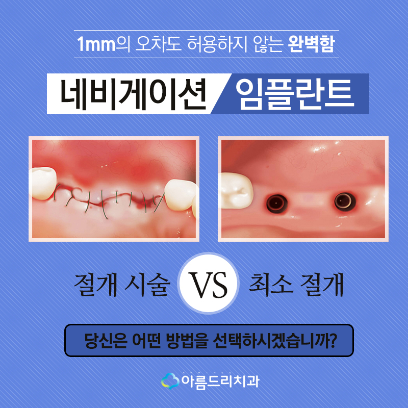 컴퓨터분석임플란트 잘하는 아름드리치과 관련 이미지 3