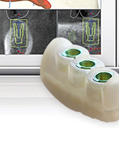 디지털임플란트 당일임플란트로 정확하고 안전하다면 관련 이미지 13