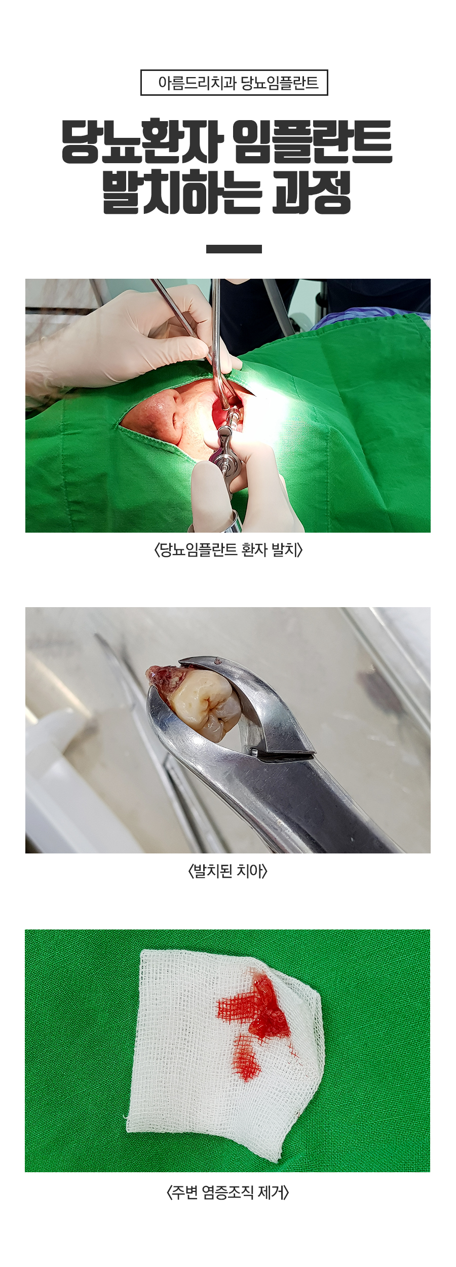 당뇨 임플란트 당뇨환자 치과 아름드리 관련 이미지 10