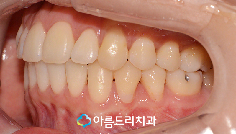 치아부정교합교정 악궁확장장치 후기는? 관련 이미지 10