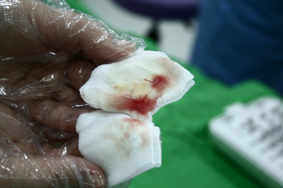 신논현역치과 PRF 자가혈 임플란트. 안전한 임플란트_아름드리 치과 관련 이미지 12