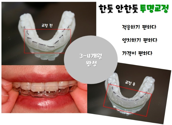 투명교정으로 가지런한 앞니 완성 관련 이미지 2