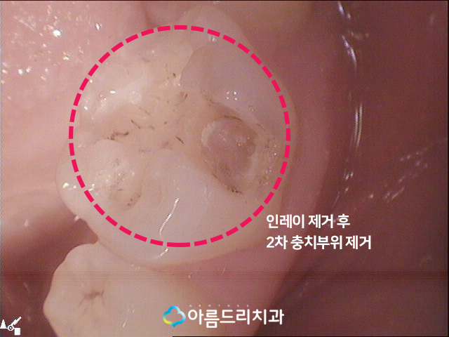 치아우식증 치료 증상과 예방법 관련 이미지 7