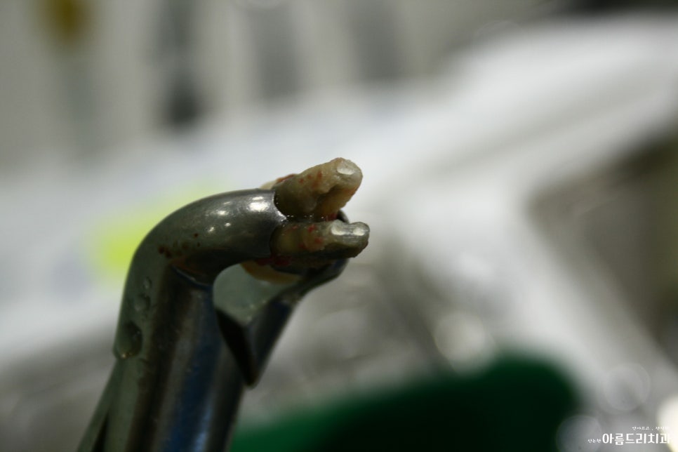 치아재식_임플란트 안 하고 치아 살릴 순 없나요?(신논현역 치과) 관련 이미지 16