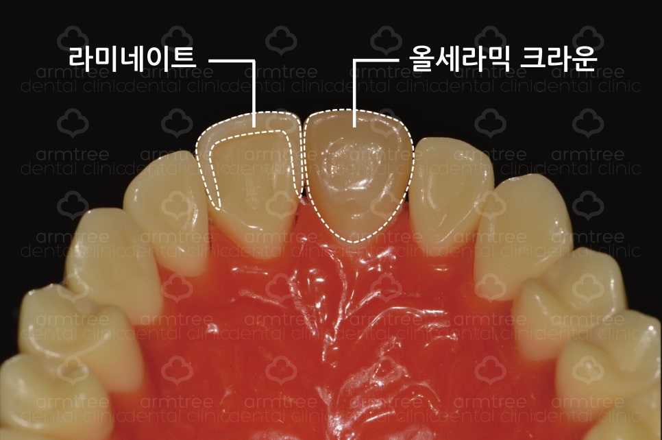 앞니 라미네이트_왜소치아 (최소삭제) 관련 이미지 6