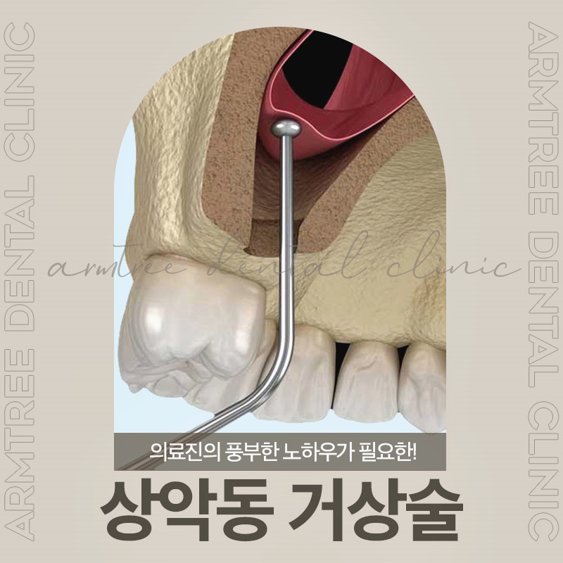 신논현역치과 상악동거상술과 임플란트는 아름드리치과에서 관련 이미지 1