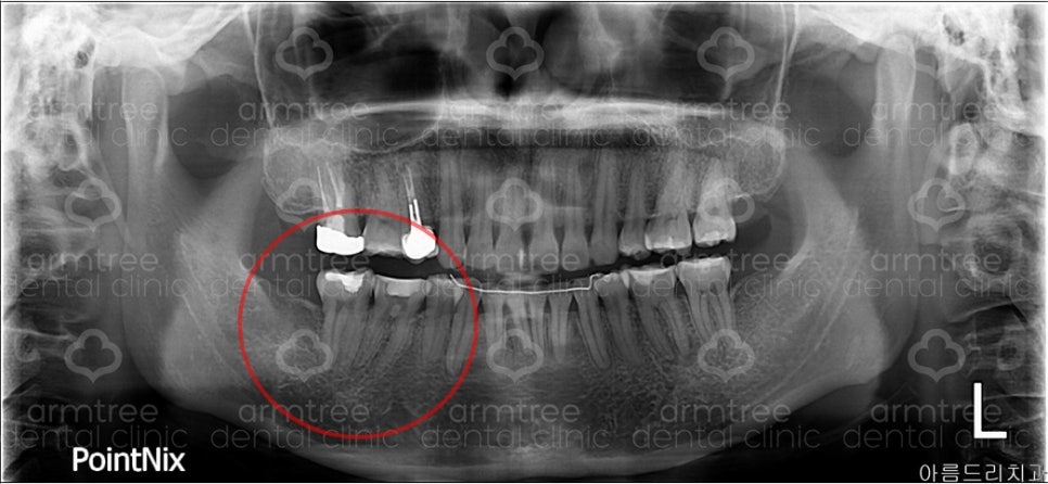 [치아 신경치료] #46,47번(오른쪽 아래 치아) 통증으로 내원 관련 이미지 3