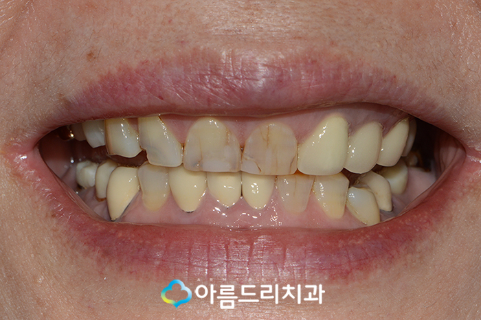 치아보철치료 앞니보철 후기 과연 관련 이미지 3