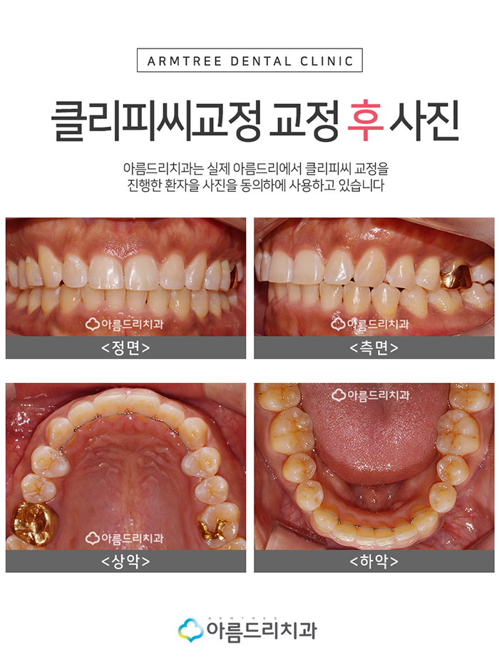 클리피시교정 덜아프고 빠르게 관련 이미지 6