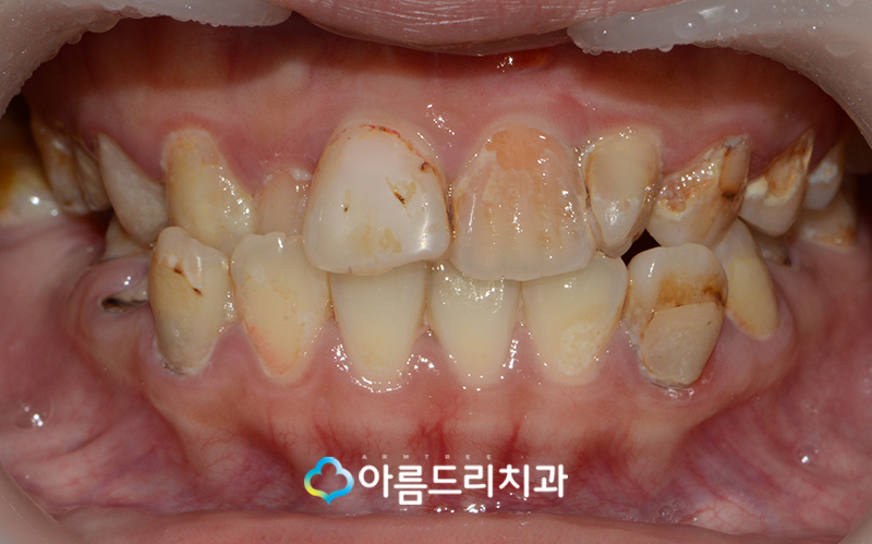 못생긴 앞니 치아라미네이트로 빠르게 관련 이미지 5