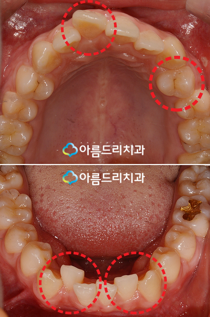 부분 설측교정비용 후기가 좋은 치과 관련 이미지 5