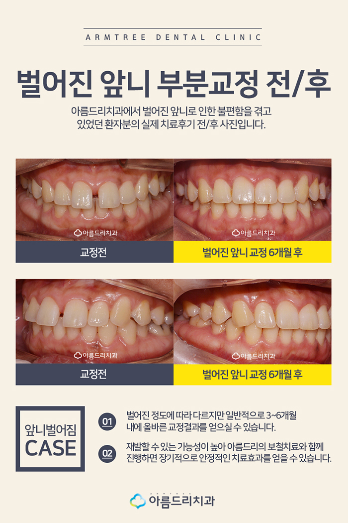 치아부분교정비용 앞니벌어짐교정 단기간에 관련 이미지 6