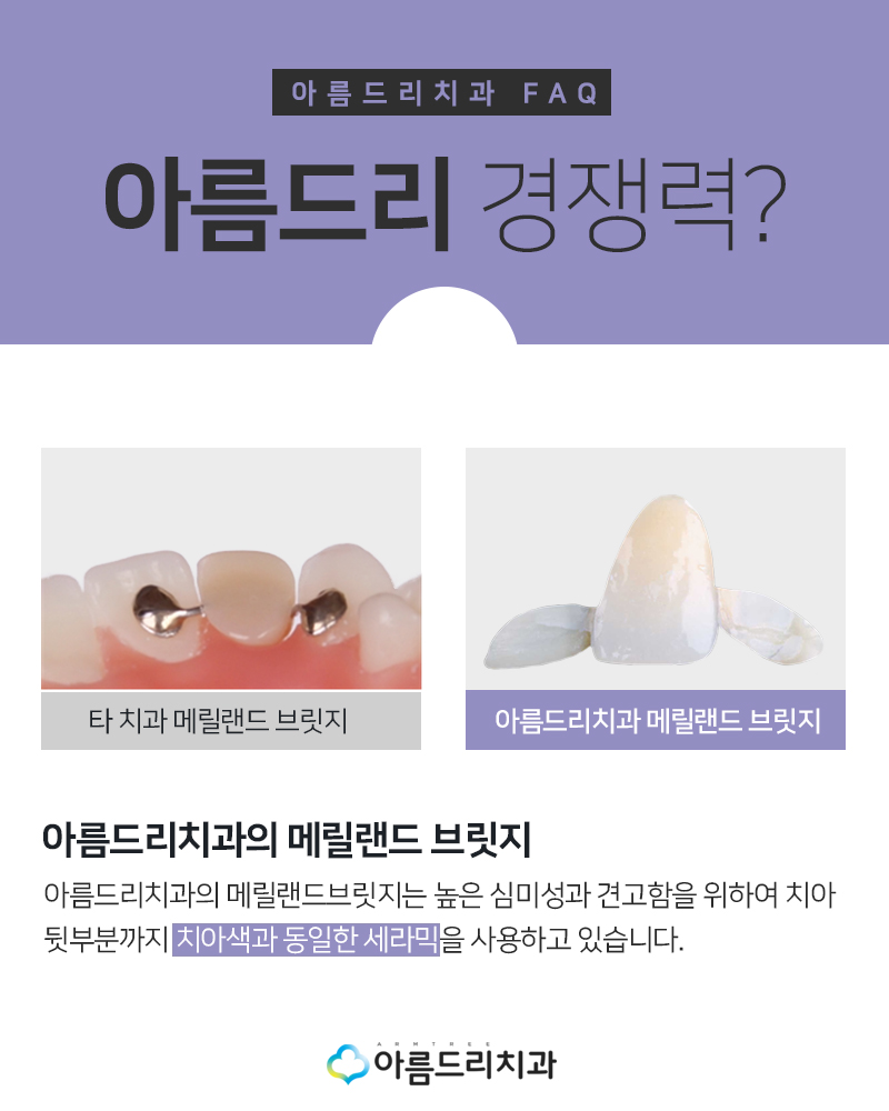 앞니브릿지 치과 치료후기 메릴랜드브릿지 관련 이미지 7