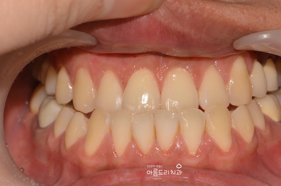 검은 잇몸! 잇몸미백으로 선홍빛 깨끗하게 관련 이미지 11