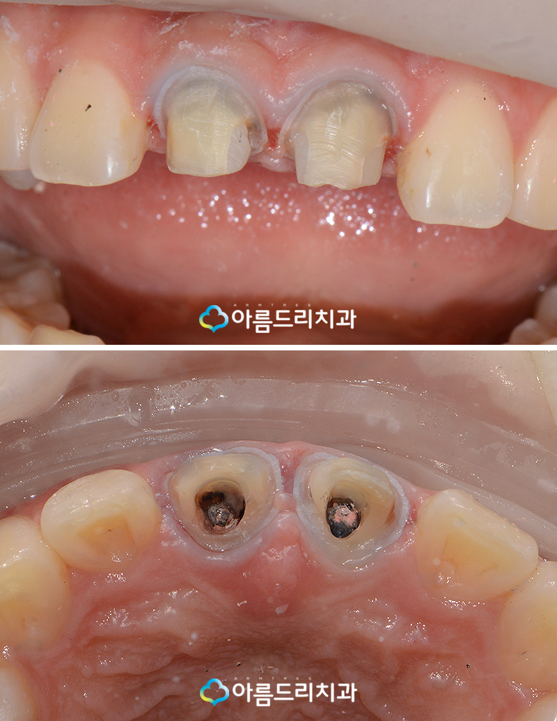 실활치미백 앞니 색깔 신경치료 치아변색 후기 관련 이미지 5