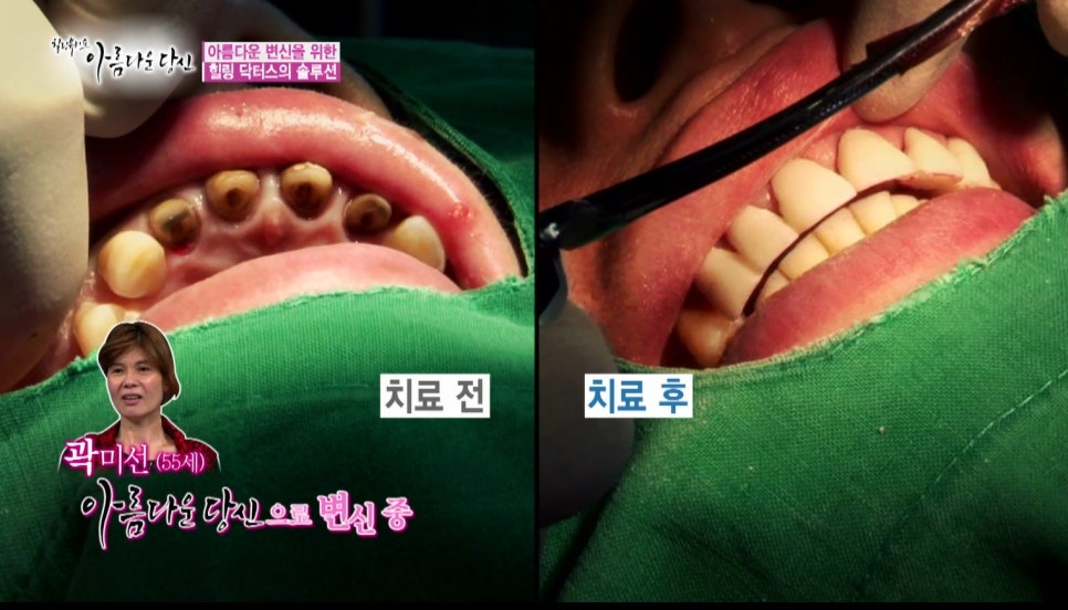 이현정원장의 아름다운 당신 시즌 1(4회 곽미선 도전자)신경치료, 심미보철, 보철치료, 올세라믹 관련 이미지 10