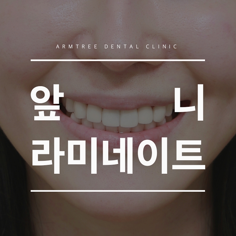 앞니라미네이트 후기가 많은 아름드리치과 관련 이미지 1