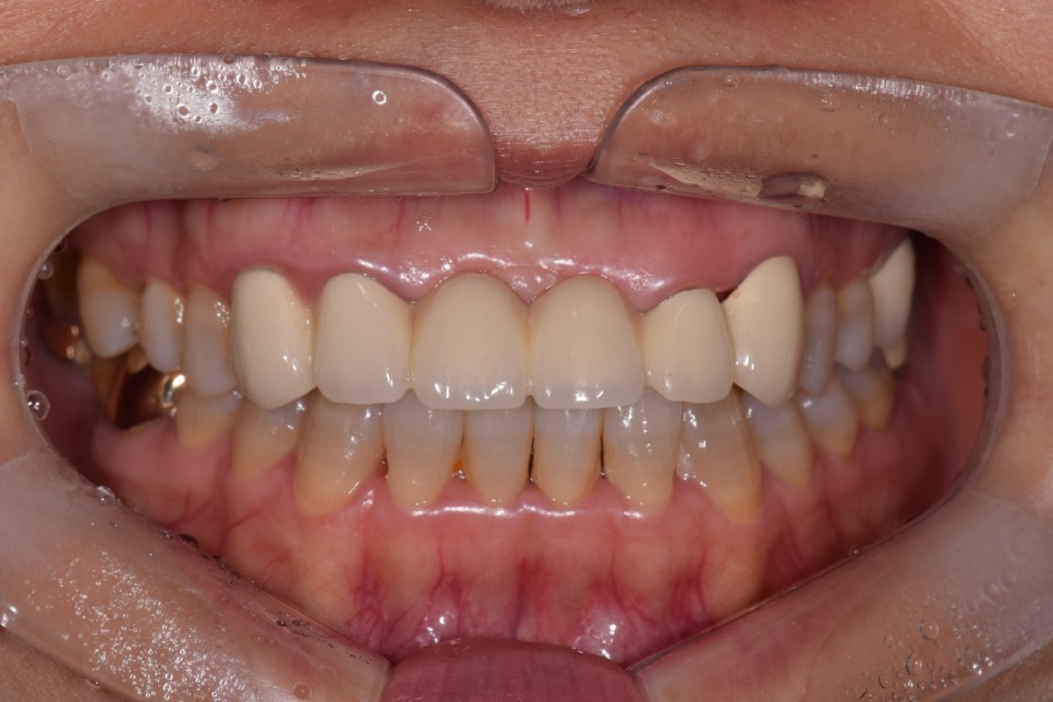 앞니 크라운 재치료 & 잇몸성형 _건강하게 . 예뻐지는 방법 관련 이미지 2