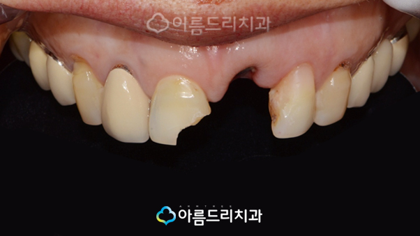 치아탈구(깨짐) 앞니임플란트 지르코니아어버트먼트 관련 이미지 4