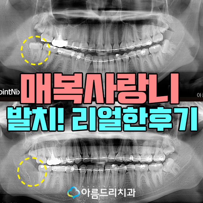 매복사랑니발치 후기 꼭 필요한가? 관련 이미지 1