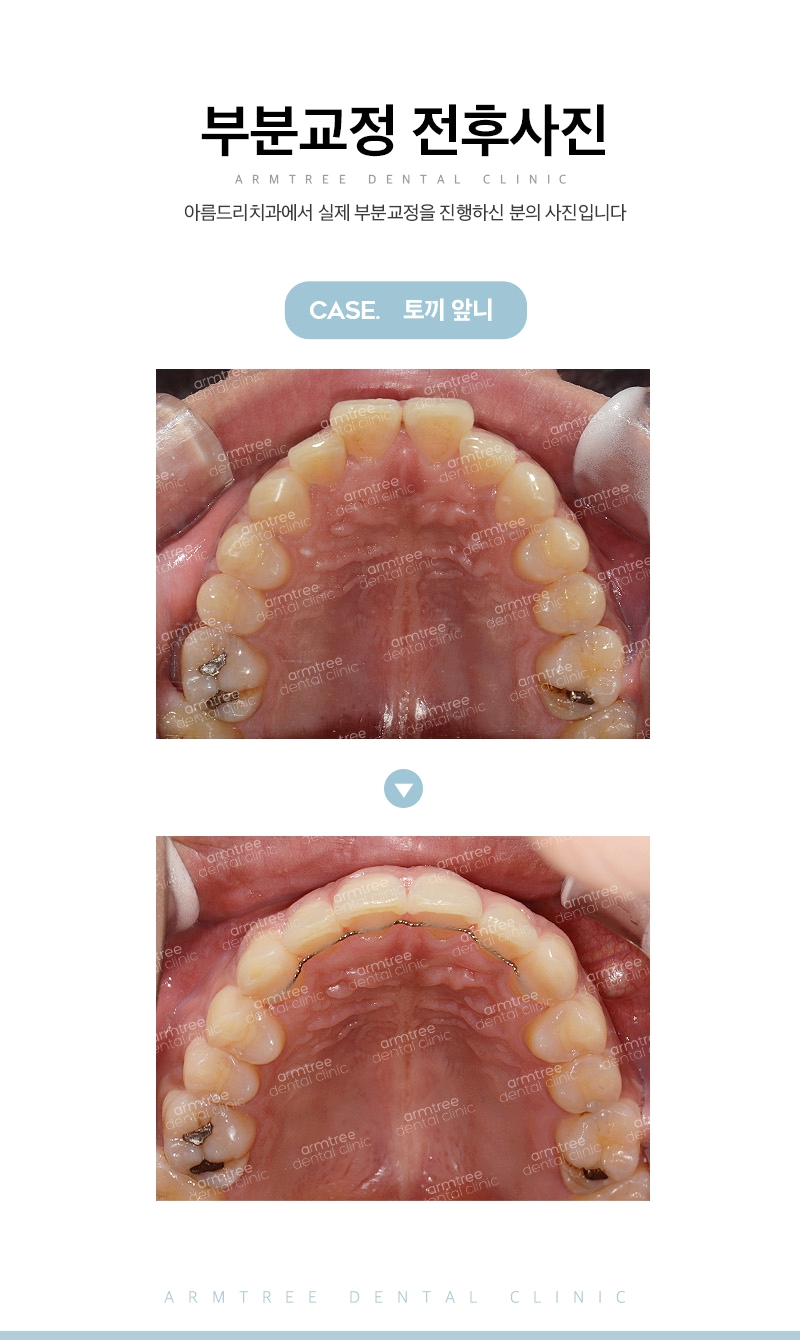 입툭튀교정 돌출앞니부분교정 후기는 아름드리치과 관련 이미지 12