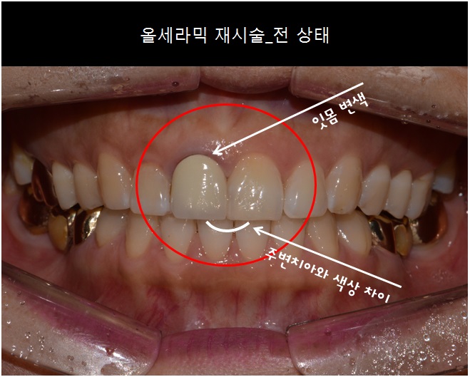 앞니 올세라믹 _재시술 (잇몸변색,메탈노출) 관련 이미지 4