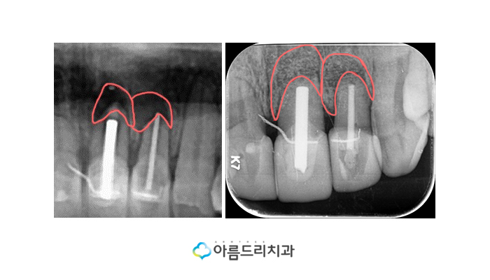 치근단절제술 후기를원한다면? 관련 이미지 9