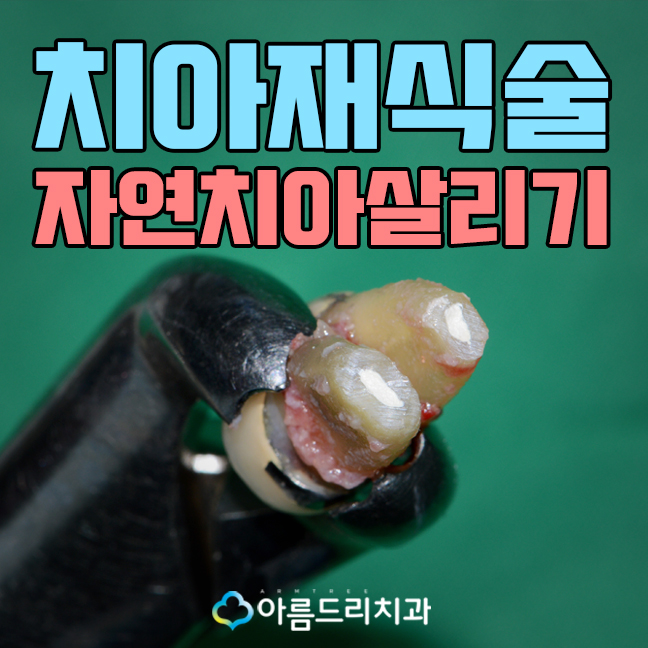 치아재식술 자연치아살리기 관련 이미지 1
