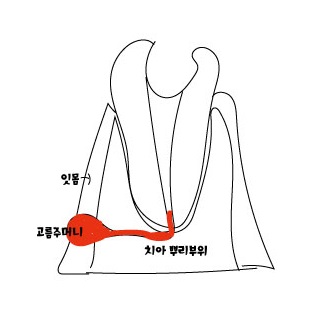 신논현역치과)잇몸고름주머니,잇몸염증,잇몸물집,치아발치 관련 이미지 6