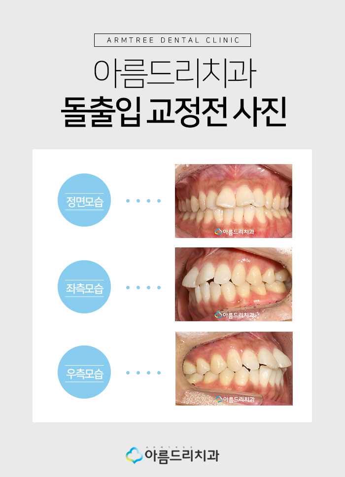 치아교정돌출입 교정후기가 중요햇 관련 이미지 3