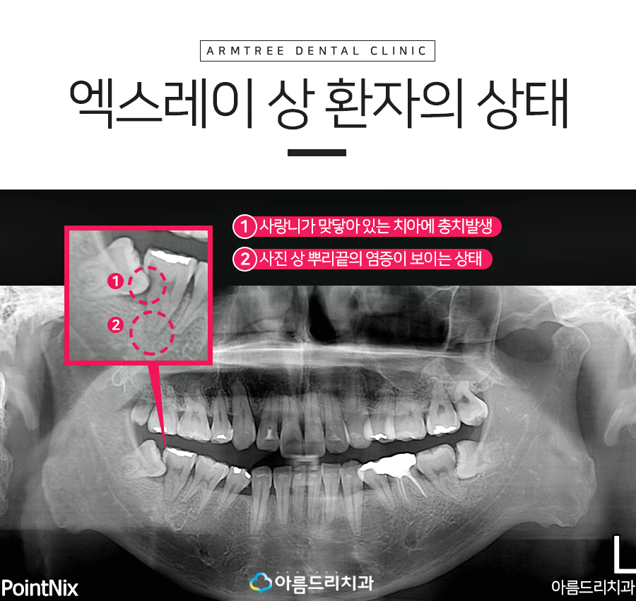 치아재식술 자연치아를지키는 방법 관련 이미지 4