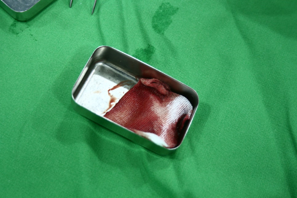 신논현역치과 PRF 자가혈 임플란트. 안전한 임플란트_아름드리 치과 관련 이미지 11