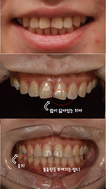 앞니 충치,앞니변색은 라미네이트로 해결(라미네이트가격문의) 관련 이미지 2