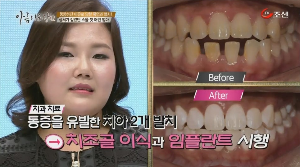이현정원장의 아름다운 당신 시즌 2 (8회 최은경 도전자) 치아교정, 임플란트, 치아미백 관련 이미지 8