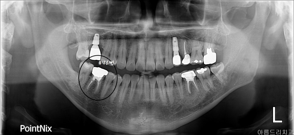 치아재식_임플란트 안 하고 치아 살릴 순 없나요?(신논현역 치과) 관련 이미지 2