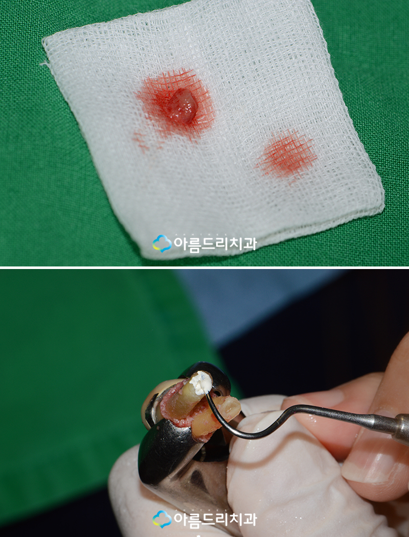 잇몸고름주머니 잇몸에고름 치아재식술 치료 관련 이미지 6