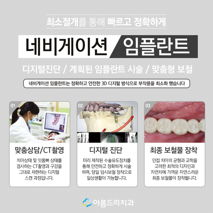 네비게이션임플란트 부작용은 저리가 관련 이미지 5