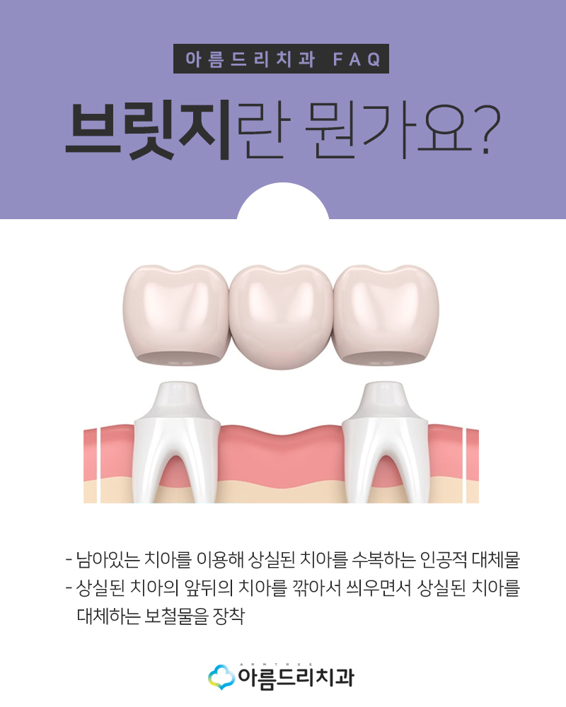 앞니브릿지 치과 치료후기 메릴랜드브릿지 관련 이미지 5