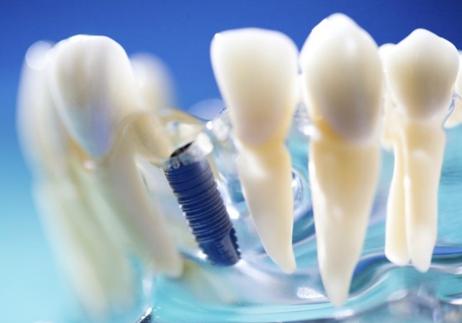 아름드리치과_빠진 치아를 그대로 두면? 관련 이미지 2