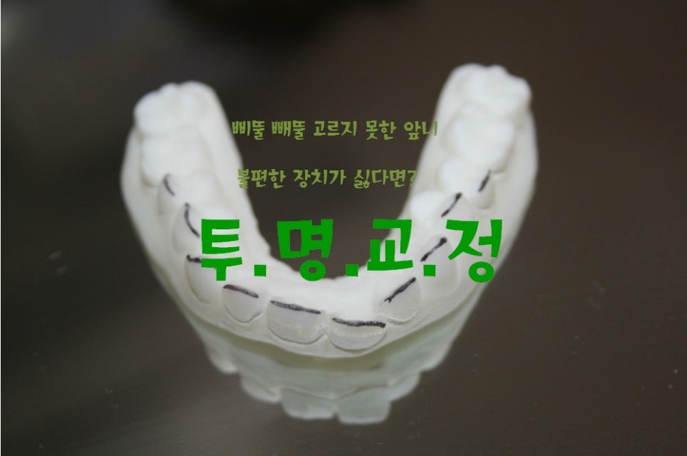 투명교정으로 가지런한 앞니 완성 관련 이미지 1