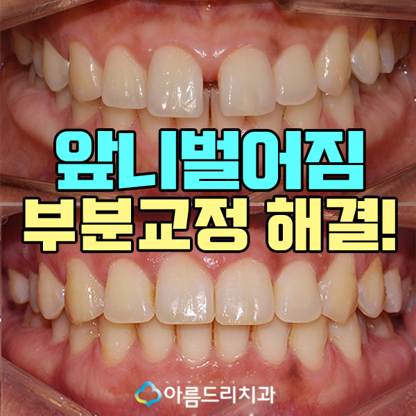 부분치아교정 앞니벌어짐 부분교정후기는! 관련 이미지 1