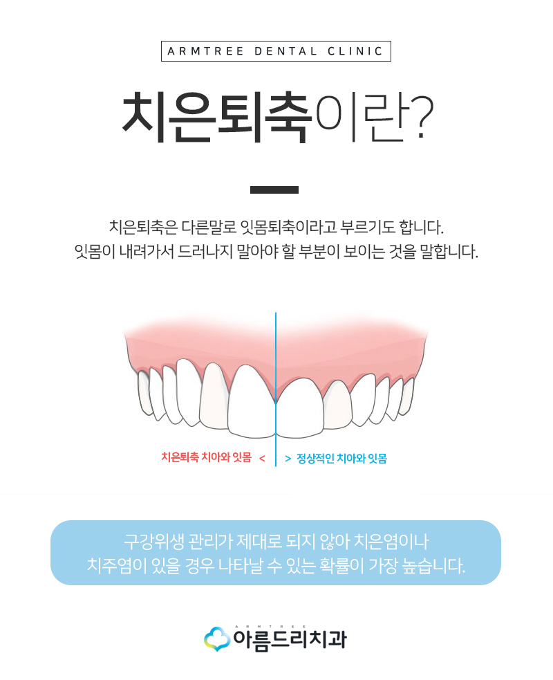 실활치미백 치은 잇몸퇴축 재생으로 동안치아 관련 이미지 7