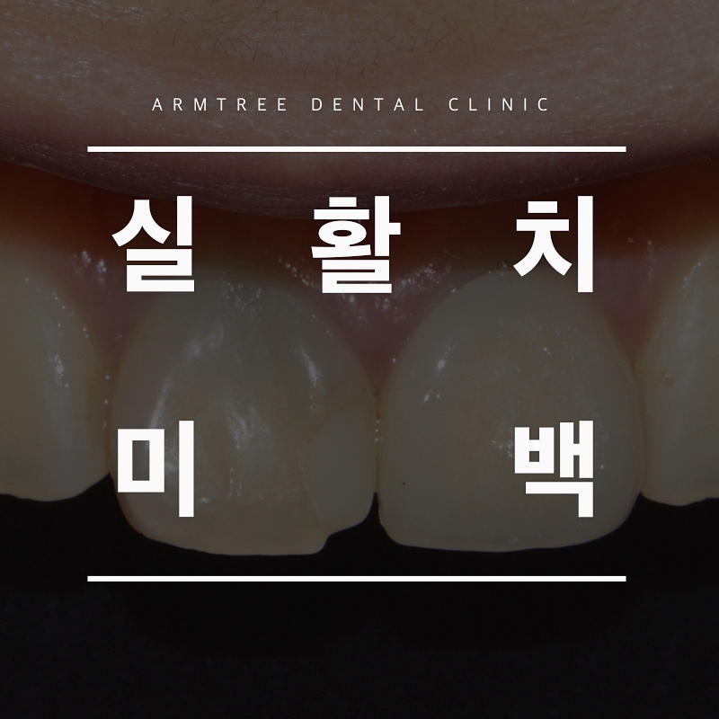 실활치미백 앞니변색 걱정NO! 신논현역 아름드리치과 관련 이미지 1