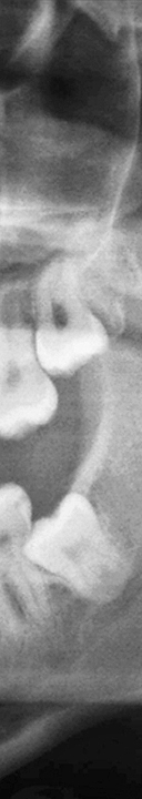 신논현역치과 사랑니 발치를 원한다면 관련 이미지 13