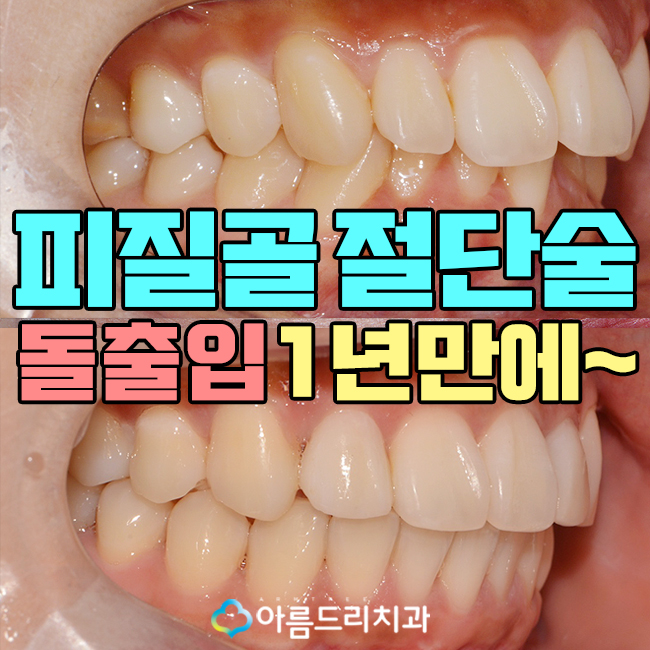 급속치아교정 코티코토미 피질골절단술 후기 관련 이미지 1